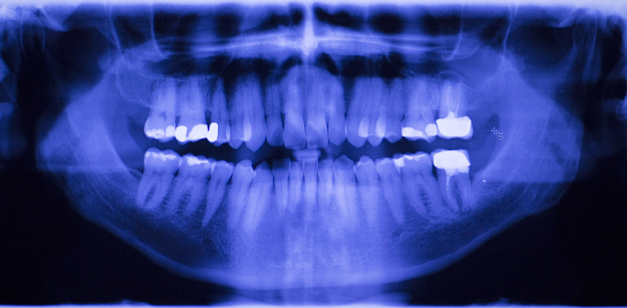 x-ray of a mouth full of teeth
